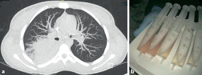 [Creatinine rise, fever and hemoptysis].