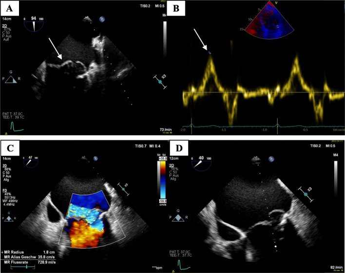 Aborted sudden cardiac death due to ventricular fibrillation in a female patient with mitral valve prolapse.