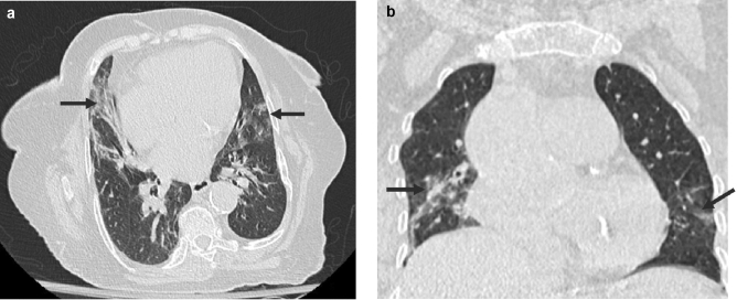 Chest CT performance and features of COVID-19 in the region of Abu Dhabi, UAE: a single institute study.