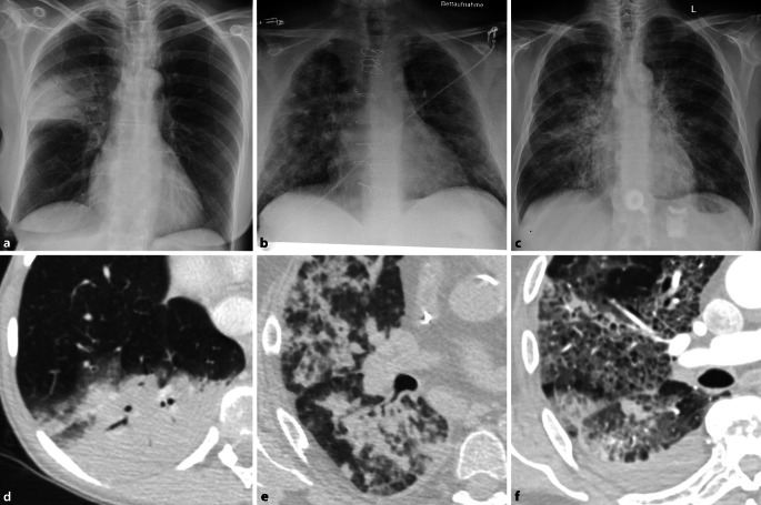 [Imaging in respiratory infections].