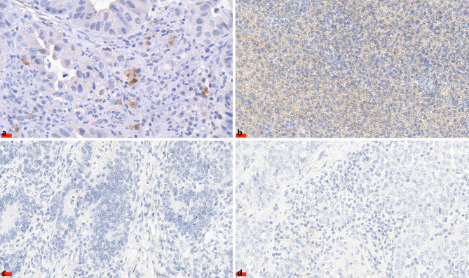 Programmed death ligand 2 expression plays a limited role in adenocarcinomas of the gastroesophageal junction after preoperative chemotherapy.