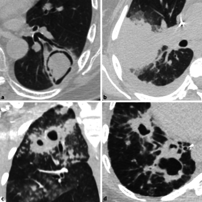 [Imaging in respiratory infections].