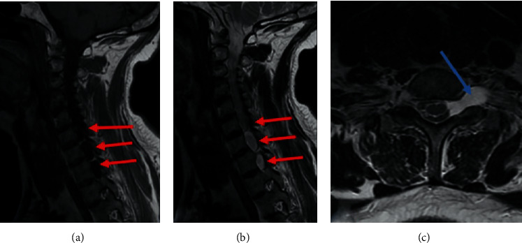 Amyotrophic Monoplegia Secondary to Posttraumatic Rupture of the Brachial Plexus's Roots: A Case Report and Review of the Literature.