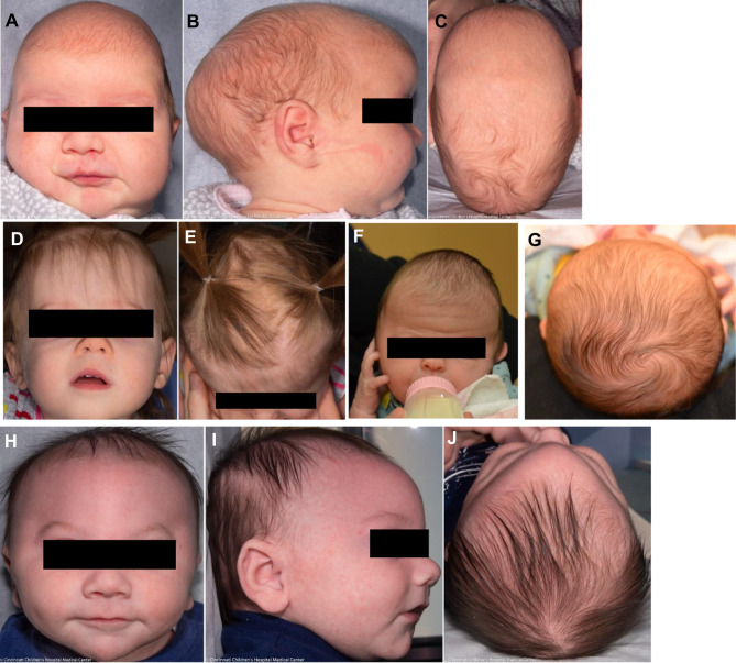 Neuro-Ophthalmological Manifestations of Craniosynostosis: Current Perspectives.