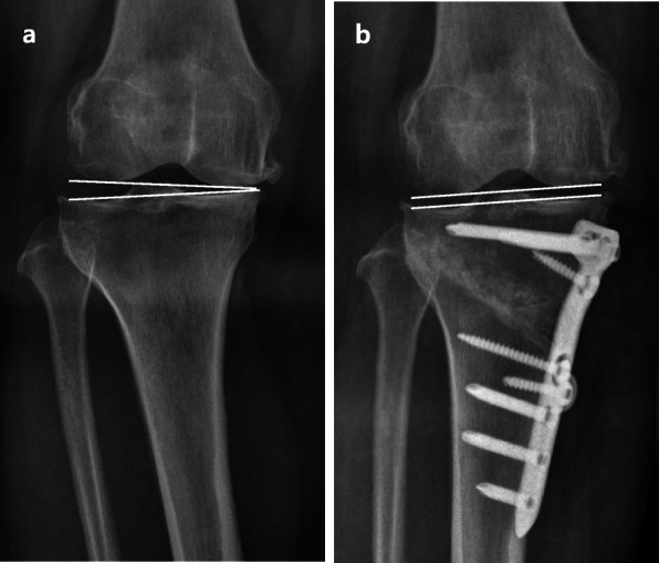 Change of joint-line convergence angle should be considered for accurate alignment correction in high tibial osteotomy.