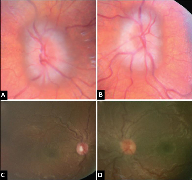 Neuro-Ophthalmological Manifestations of Craniosynostosis: Current Perspectives.