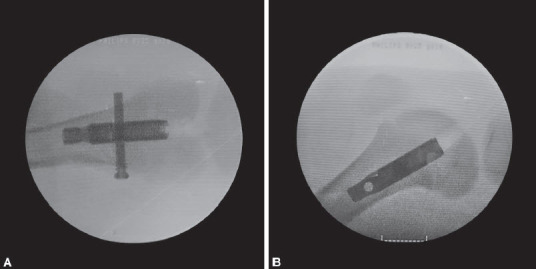 Does Retrograde Femoral Nailing through a Normal Physis Impair Growth? An Experimental Porcine Model.