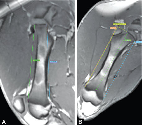 Does Retrograde Femoral Nailing through a Normal Physis Impair Growth? An Experimental Porcine Model.