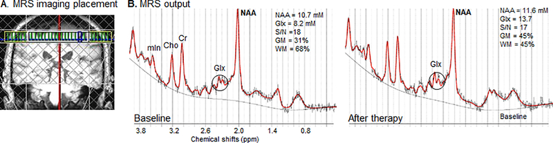 N-Acetylaspartate Biomarker of Stroke Recovery: A Case Series Study.