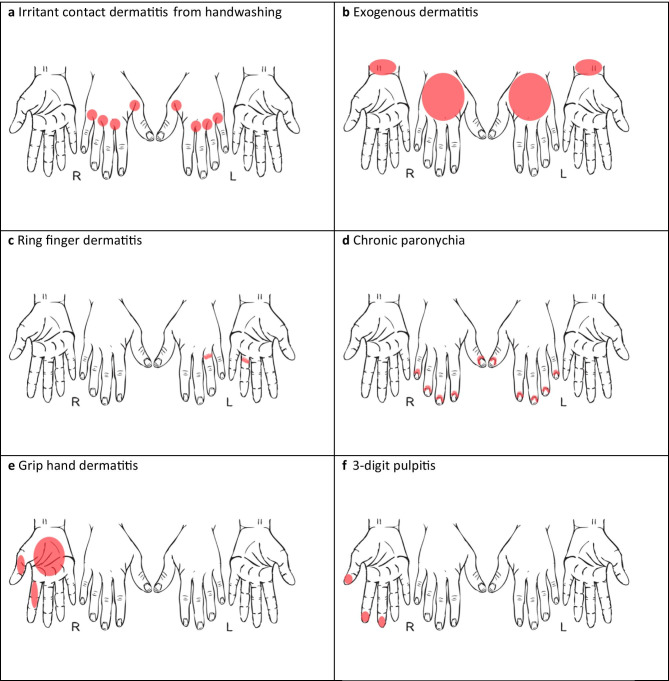 Occupational Contact Dermatitis: An Individualized Approach to the Worker with Dermatitis.