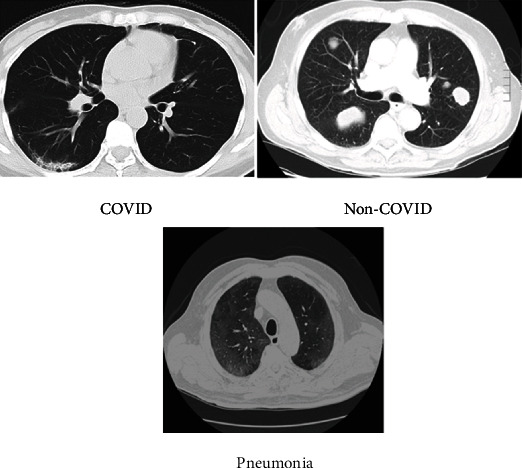 A Rapid Artificial Intelligence-Based Computer-Aided Diagnosis System for COVID-19 Classification from CT Images.