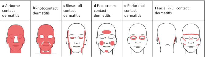 Occupational Contact Dermatitis: An Individualized Approach to the Worker with Dermatitis.