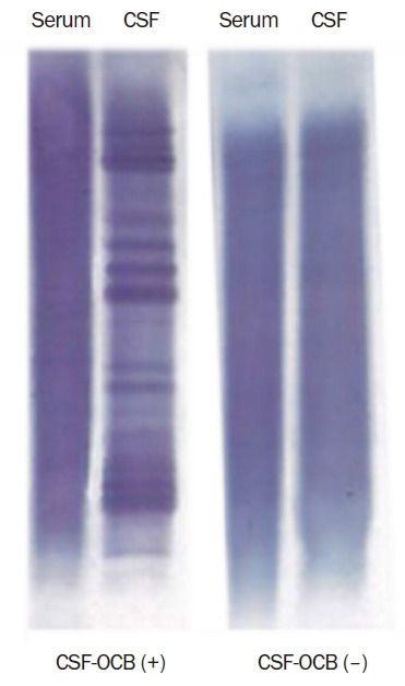 Initial cerebrospinal fluid-restricted oligoclonal bands associate with anti-N-methyl-D-aspartate receptor encephalitis severity: a pilot study.