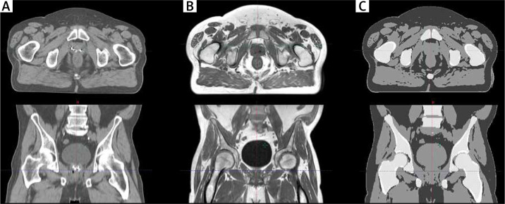 Validation of the dosimetric and geometric accuracy of MR-only treatment planning solution for prostate cancer radiotherapy.