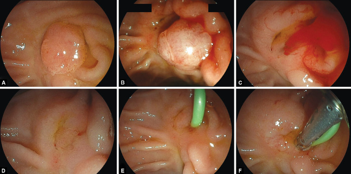 Cold Snare Papillectomy for Re-redo Endoscopic Resection of a Defiant Adenoma Recurrence with a Unique Growth Pattern.