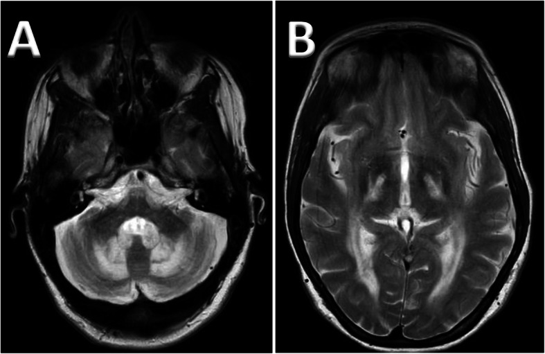 Cerebrotendinous Xanthomatosis: diversity of presentation and refining treatment with chenodeoxycholic acid.