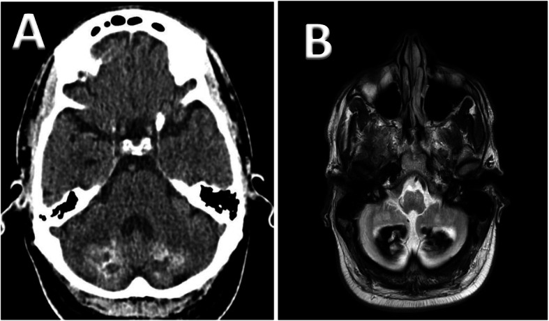 Cerebrotendinous Xanthomatosis: diversity of presentation and refining treatment with chenodeoxycholic acid.