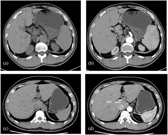 Normotensive presentation in primary aldosteronism: A report of two cases.