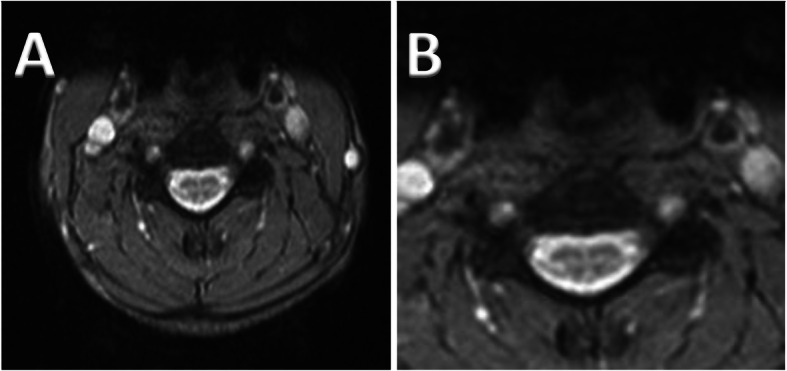 Cerebrotendinous Xanthomatosis: diversity of presentation and refining treatment with chenodeoxycholic acid.