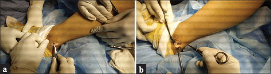 Peroneus Longus Tendon Autograft for Anterior Cruciate Ligament Reconstruction: A Safe and Effective Alternative in Nonathletic Patients.