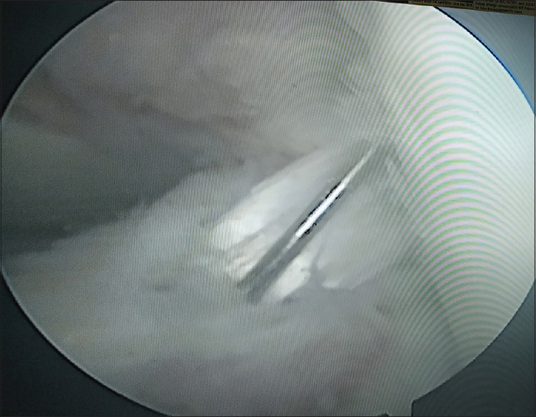Peroneus Longus Tendon Autograft for Anterior Cruciate Ligament Reconstruction: A Safe and Effective Alternative in Nonathletic Patients.