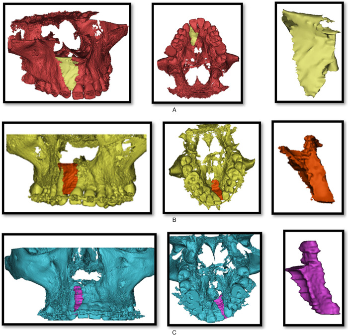 The effectiveness of mineralized plasmatic matrix in the closure of alveolar clefts with volumetric assessment.