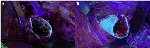 Fluorescent tetracycline bone labeling as an intraoperative tool to debride necrotic bone during septic hip revision: a preliminary case series.