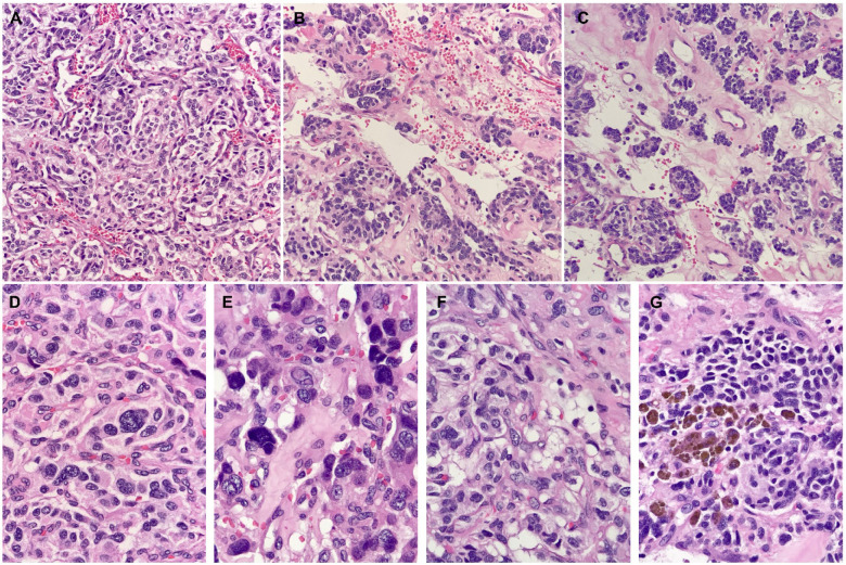 Large Retroperitoneal Paraganglioma Associated with Germline Mutation of the Succinate Dehydrogenase Gene.