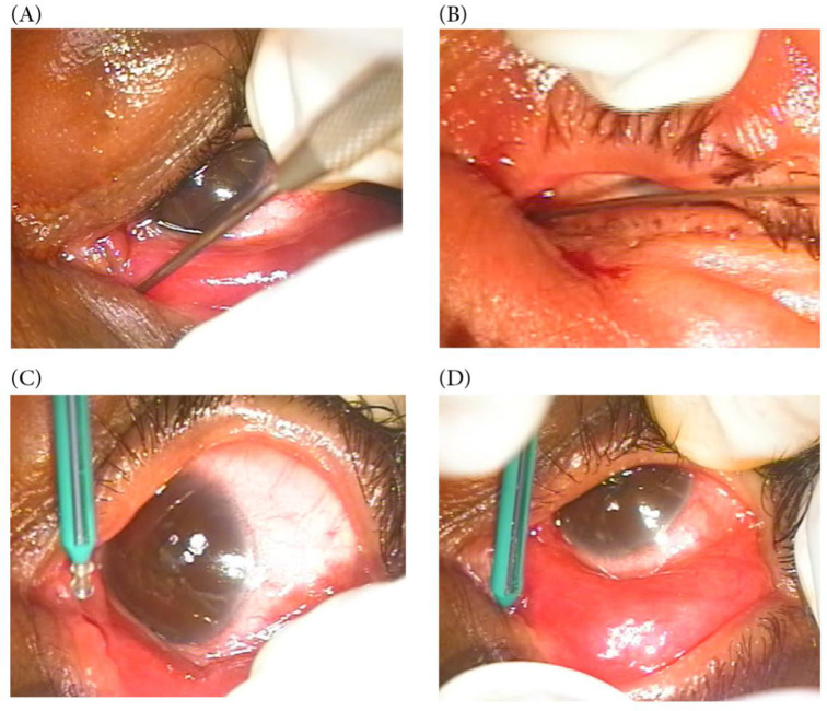 Lacrimal stenting versus three-snip punctoplasty for treatment of punctal stenosis or occlusion: an open- label, randomized clinical trial.