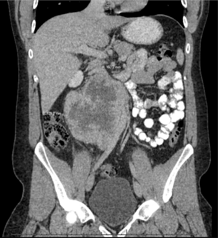 Large Retroperitoneal Paraganglioma Associated with Germline Mutation of the Succinate Dehydrogenase Gene.