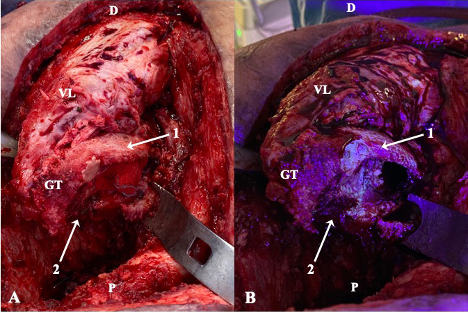 Fluorescent tetracycline bone labeling as an intraoperative tool to debride necrotic bone during septic hip revision: a preliminary case series.