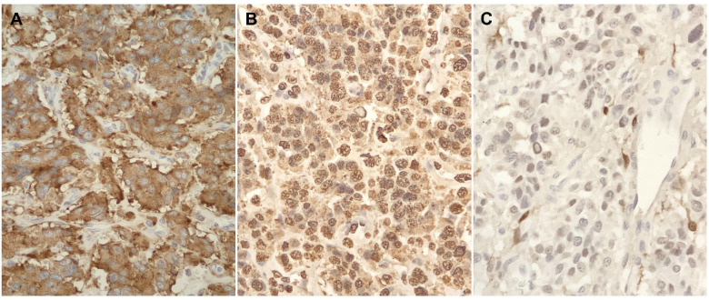 Large Retroperitoneal Paraganglioma Associated with Germline Mutation of the Succinate Dehydrogenase Gene.