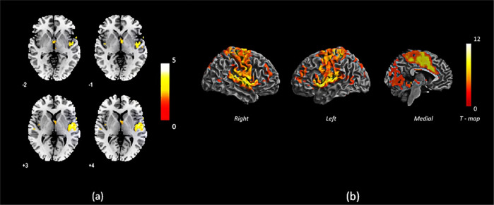 Conceptual disorganization and redistribution of resting-state cortical hubs in untreated first-episode psychosis: A 7T study.