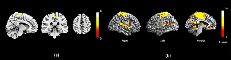 Conceptual disorganization and redistribution of resting-state cortical hubs in untreated first-episode psychosis: A 7T study.