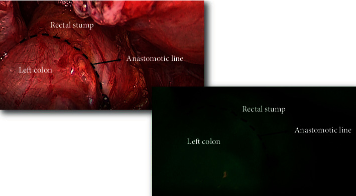 Laparoscopic Versus Open Hartmann Reversal: A Case-Control Study.