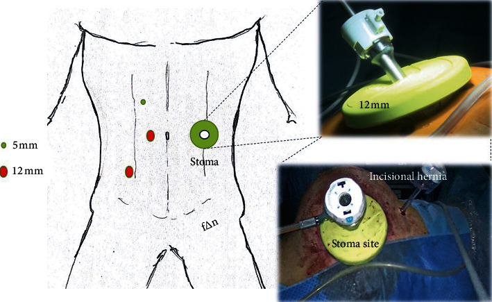 Laparoscopic Versus Open Hartmann Reversal: A Case-Control Study.