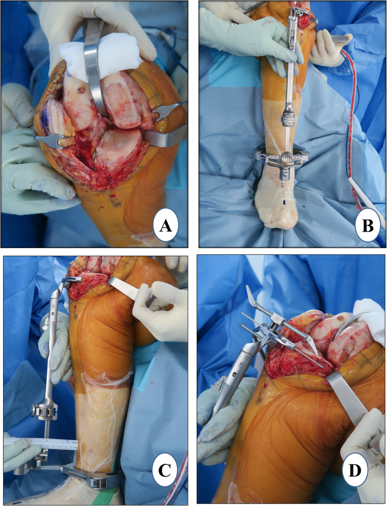 Evidence-based surgical technique for medial unicompartmental knee arthroplasty.