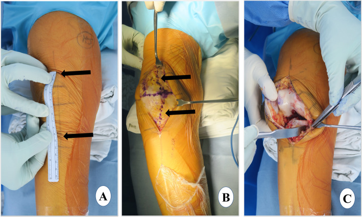 Evidence-based surgical technique for medial unicompartmental knee arthroplasty.