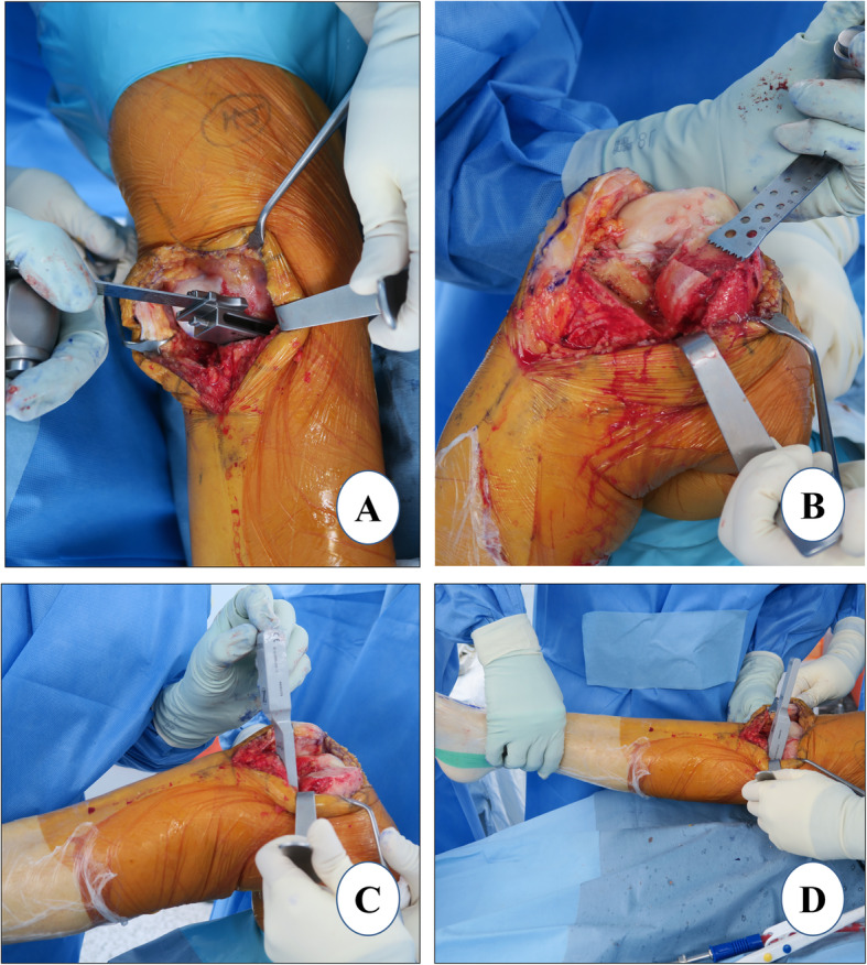 Evidence-based surgical technique for medial unicompartmental knee arthroplasty.