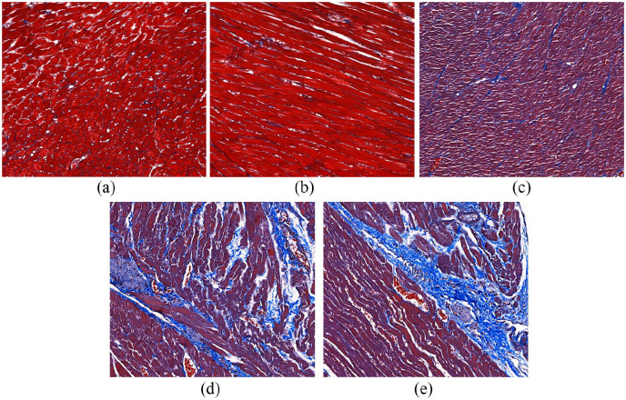 PM2.5 inducing myocardial fibrosis mediated by Ang II/ERK1/2/TGF-β<sub>1</sub> signaling pathway in mice model.