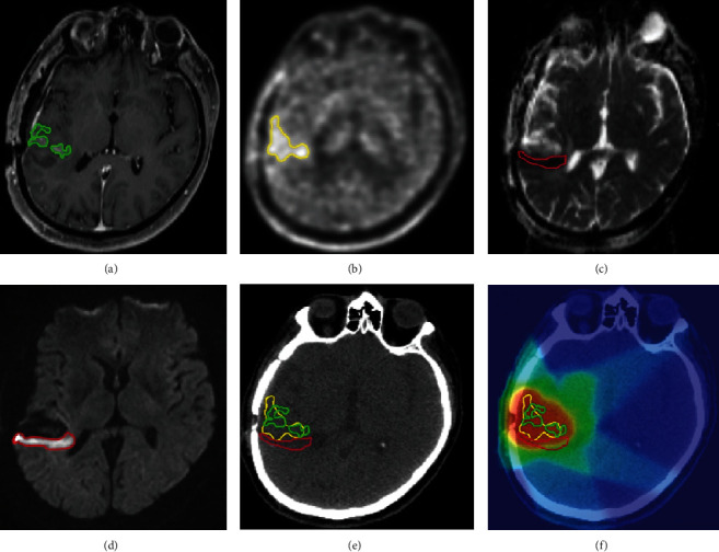 Comparison of Amino Acid PET to Advanced and Emerging MRI Techniques for Neurooncology Imaging: A Systematic Review of the Recent Studies.