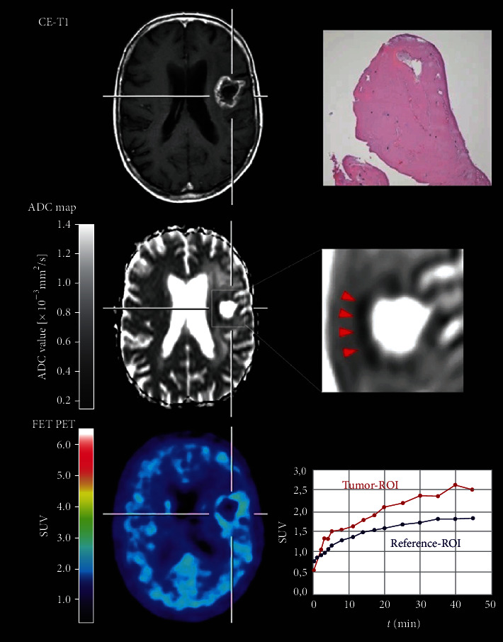 Comparison of Amino Acid PET to Advanced and Emerging MRI Techniques for Neurooncology Imaging: A Systematic Review of the Recent Studies.