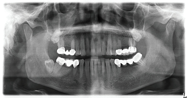 Idiopathic coronal resorption in impacted permanent teeth and its relationship with age: radiologic study.