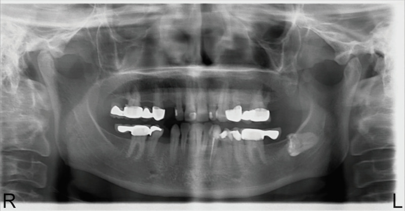 Idiopathic coronal resorption in impacted permanent teeth and its relationship with age: radiologic study.