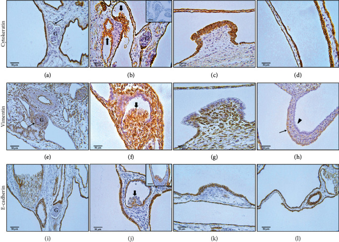 Histomorphology and Immunohistochemistry of a Congenital Nephromegaly Demonstrate Concurrent Features of Heritable and Acquired Cystic Nephropathies in a Girgentana Goat (<i>Capra falconeri</i>).