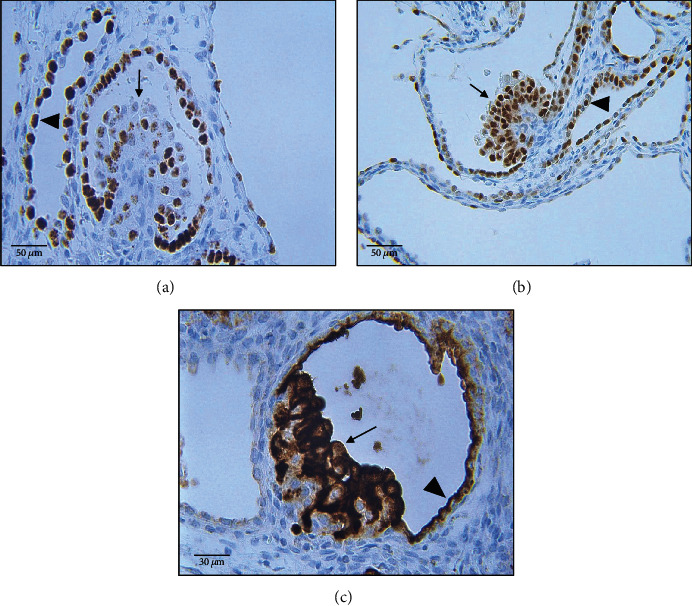 Histomorphology and Immunohistochemistry of a Congenital Nephromegaly Demonstrate Concurrent Features of Heritable and Acquired Cystic Nephropathies in a Girgentana Goat (<i>Capra falconeri</i>).