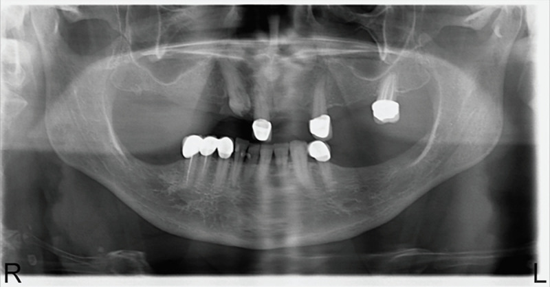 Idiopathic coronal resorption in impacted permanent teeth and its relationship with age: radiologic study.