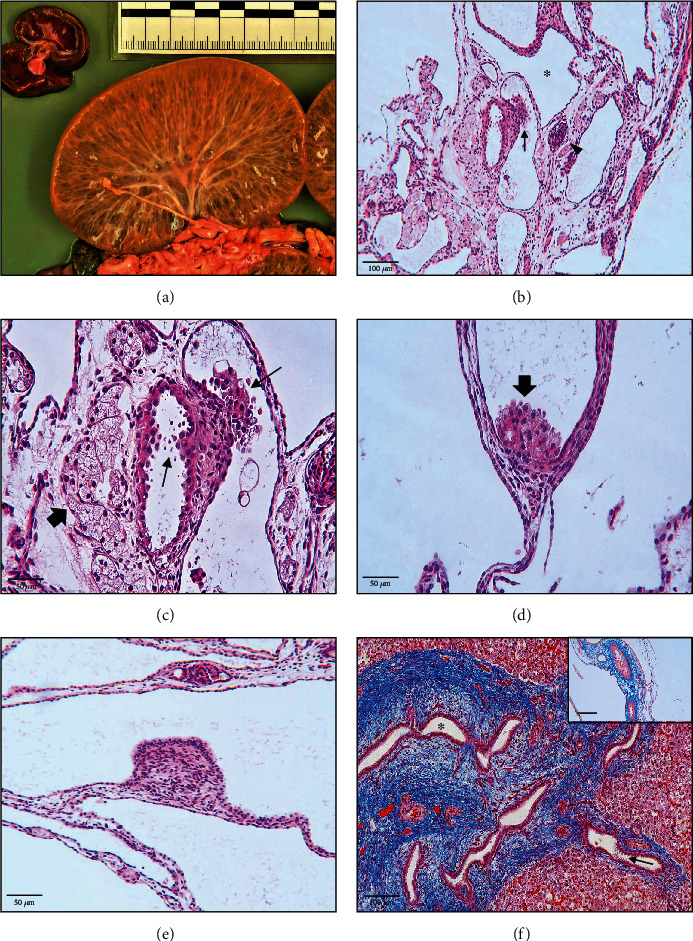 Histomorphology and Immunohistochemistry of a Congenital Nephromegaly Demonstrate Concurrent Features of Heritable and Acquired Cystic Nephropathies in a Girgentana Goat (<i>Capra falconeri</i>).