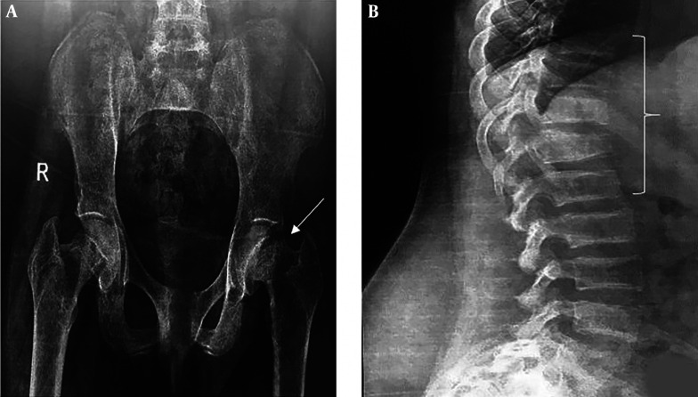 A Pediatric Parathyroid Carcinoma: An Unusual Clinical Presentation and Mini-review.