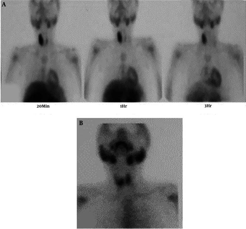 A Pediatric Parathyroid Carcinoma: An Unusual Clinical Presentation and Mini-review.